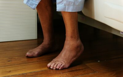 Managing Swelling and Foot Fatigue